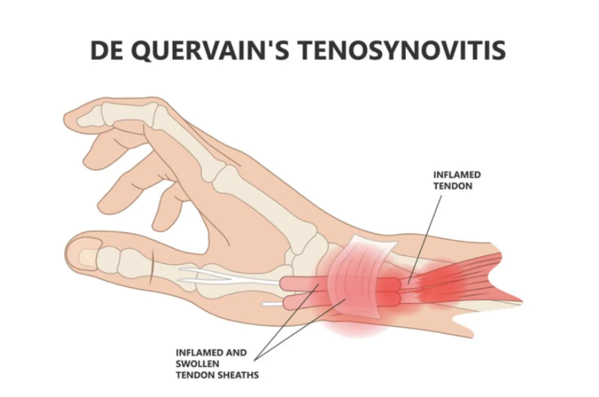 Illustration of De Quervain's tenosynovitis showing inflamed tendons at the base of the thumb